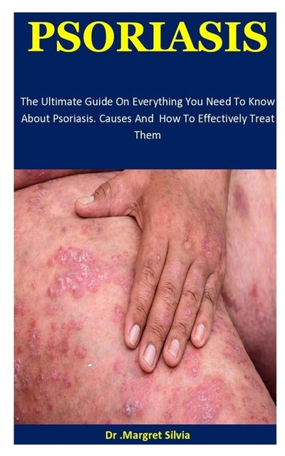 Psoriasis: The Ultimate Guide On Everything You Need To Know About Psoriasis. Causes And How To Effectively Treat Them by Silvia, Margret