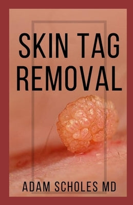 Skin Tag Removal: All You Need To Know About Methods of removing Mole, Wart and Skin Tag Naturally by Scholes MD, Adam